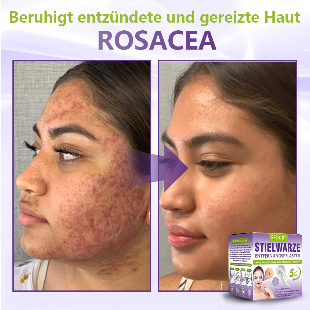 GFOUK® Lösliches Mikronadel-Pflaster zur Entfernung von Hautanhängseln auf Pflanzenbasis🍀🍀