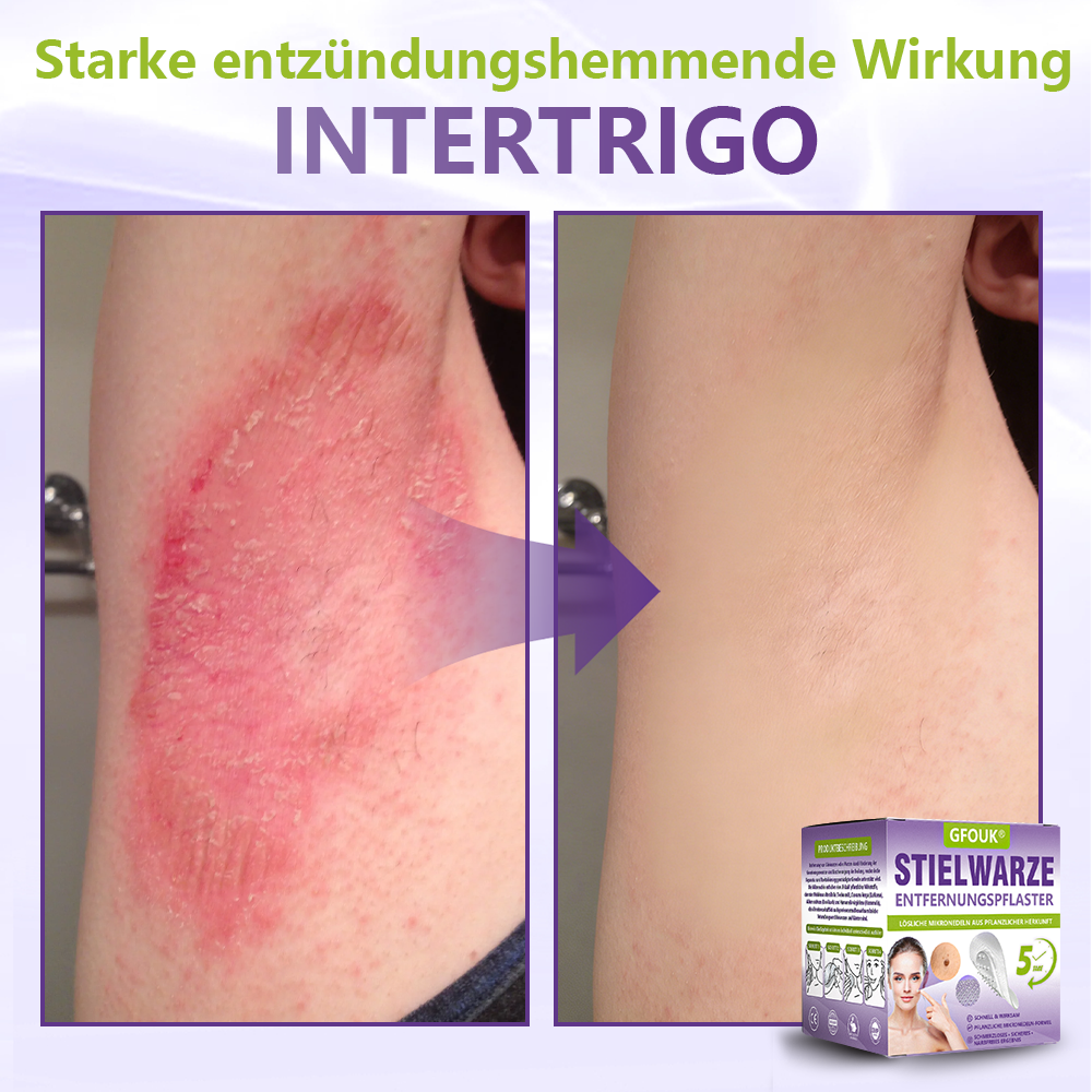 GFOUK® Lösliches Mikronadel-Pflaster zur Entfernung von Hautanhängseln auf Pflanzenbasis🍀🍀