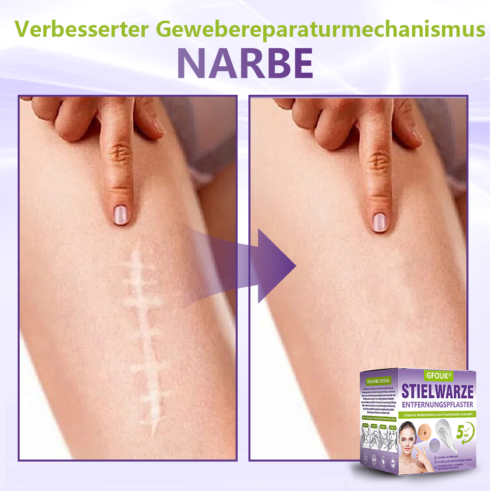 GFOUK® Lösliches Mikronadel-Pflaster zur Entfernung von Hautanhängseln auf Pflanzenbasis🍀🍀