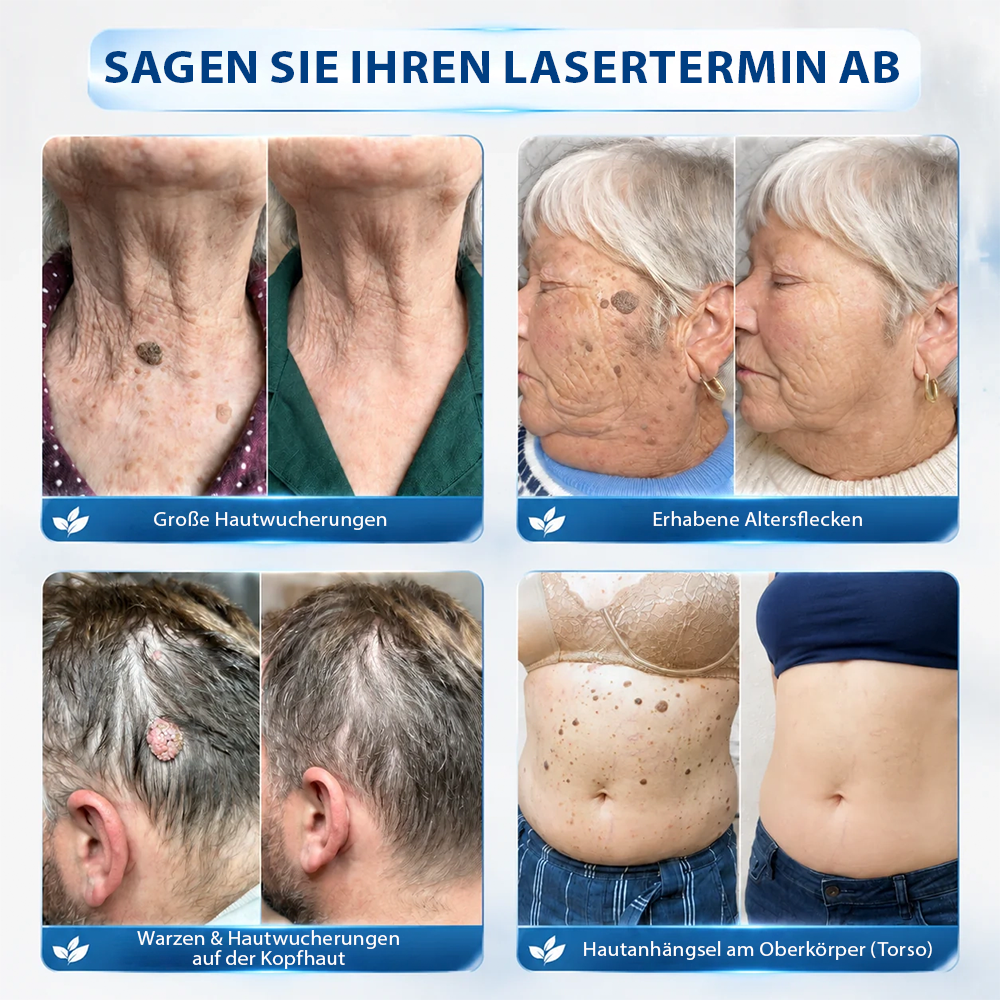 Hergestellt und versandt aus Deutschland ✨ Evolvion® 𝟕-Tage-Hautanhangs- & Pigmentflecken-Entferner – Schmerzfreie und narbenfreie fortschrittliche Lösung zur Beseitigung von Hautunreinheiten mit Roll-On-Pen 🌼