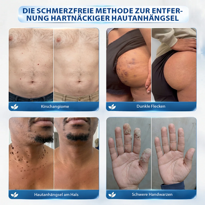 Hergestellt und versandt aus Deutschland ✨ Evolvion® 𝟕-Tage-Hautanhangs- & Pigmentflecken-Entferner – Schmerzfreie und narbenfreie fortschrittliche Lösung zur Beseitigung von Hautunreinheiten mit Roll-On-Pen 🌼