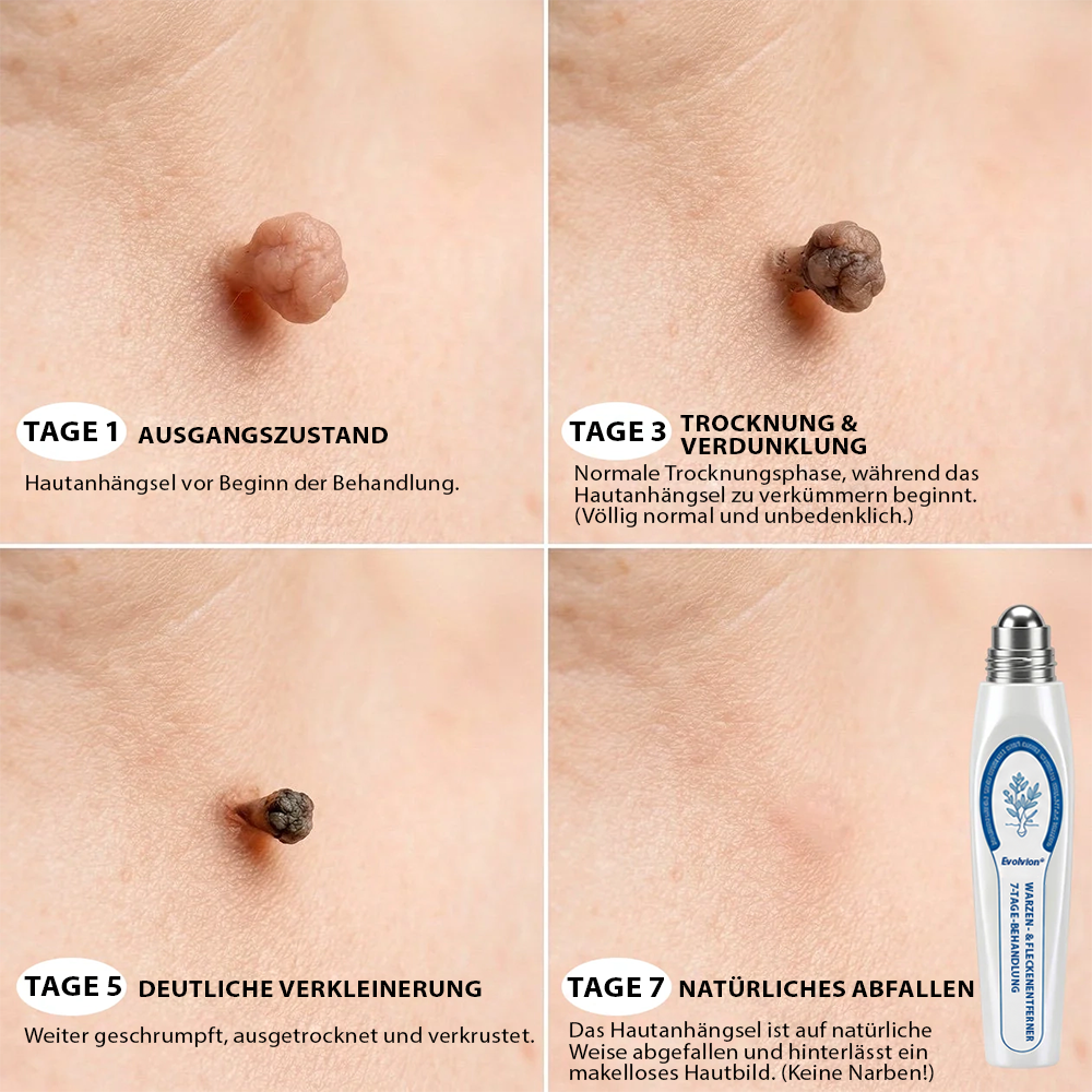Hergestellt und versandt aus Deutschland ✨ Evolvion® 𝟕-Tage-Hautanhangs- & Pigmentflecken-Entferner – Schmerzfreie und narbenfreie fortschrittliche Lösung zur Beseitigung von Hautunreinheiten mit Roll-On-Pen 🌼
