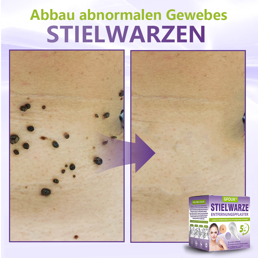 GFOUK® Lösliches Mikronadel-Pflaster zur Entfernung von Hautanhängseln auf Pflanzenbasis🍀🍀