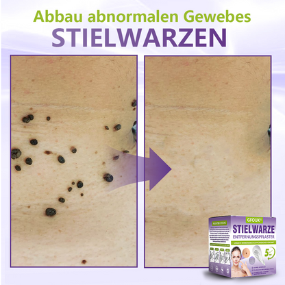 GFOUK® Lösliches Mikronadel-Pflaster zur Entfernung von Hautanhängseln auf Pflanzenbasis🍀🍀