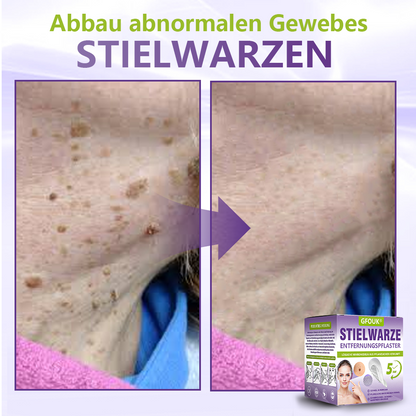 GFOUK® Lösliches Mikronadel-Pflaster zur Entfernung von Hautanhängseln auf Pflanzenbasis🍀🍀