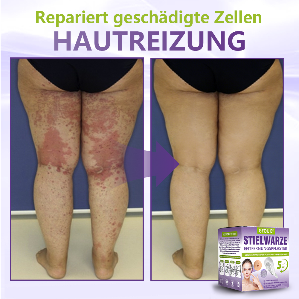 GFOUK® Lösliches Mikronadel-Pflaster zur Entfernung von Hautanhängseln auf Pflanzenbasis🍀🍀