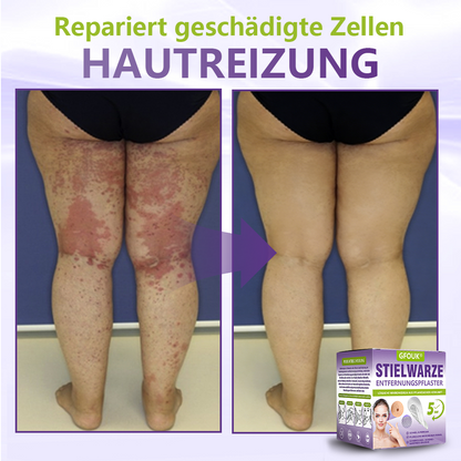 GFOUK® Lösliches Mikronadel-Pflaster zur Entfernung von Hautanhängseln auf Pflanzenbasis🍀🍀