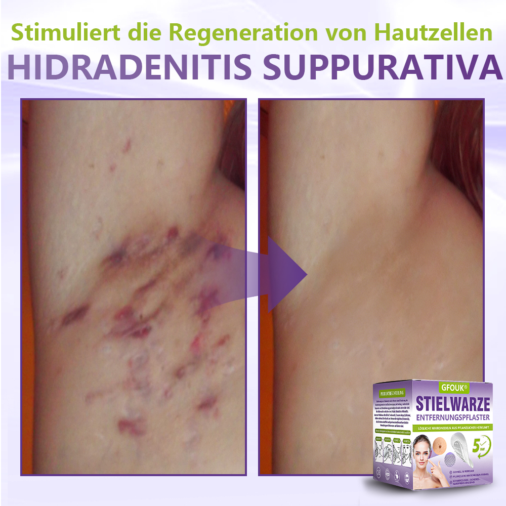 GFOUK® Lösliches Mikronadel-Pflaster zur Entfernung von Hautanhängseln auf Pflanzenbasis🍀🍀